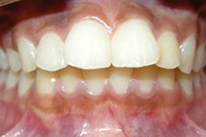 Bọc răng sứ có hết hô không?