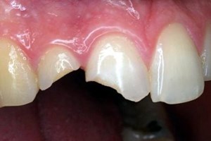 Bọc răng sứ có an toàn không?