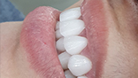VENEER